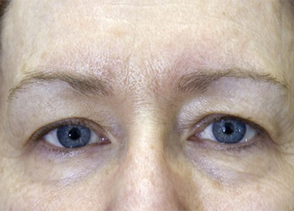 Rajeunissement du visage - Après