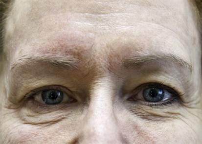 Rajeunissement du visage - Avant