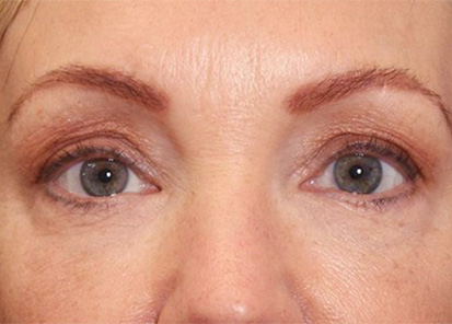 Rajeunissement du visage - Après