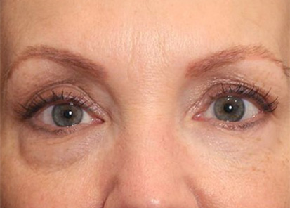 Rajeunissement du visage - Avant