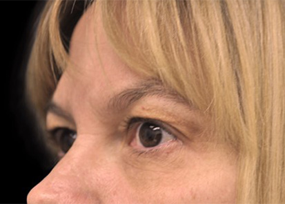 Rajeunissement du visage - Après