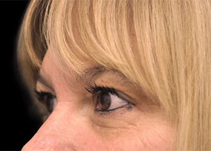 Rajeunissement du visage - Avant