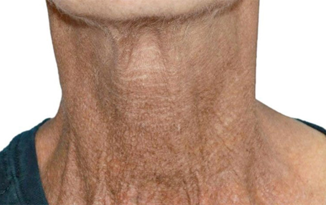 Remodelage corporel Remodelage corporel