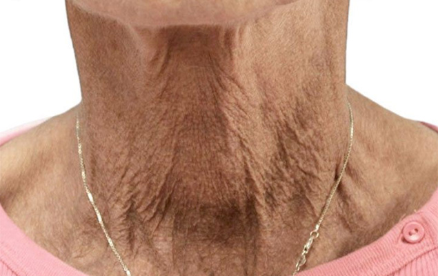 Remodelage corporel Remodelage corporel