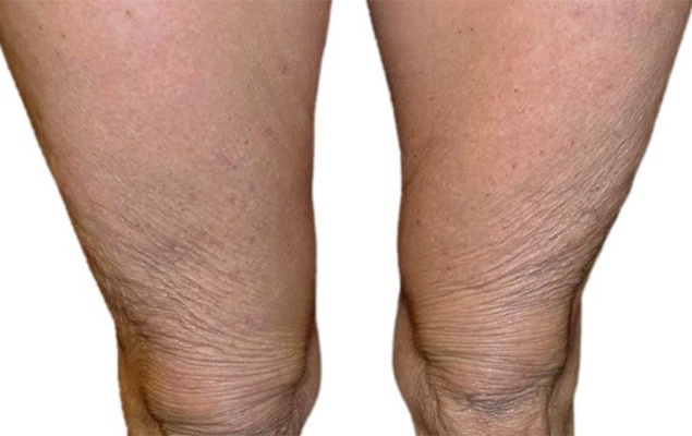 Remodelage corporel Remodelage corporel