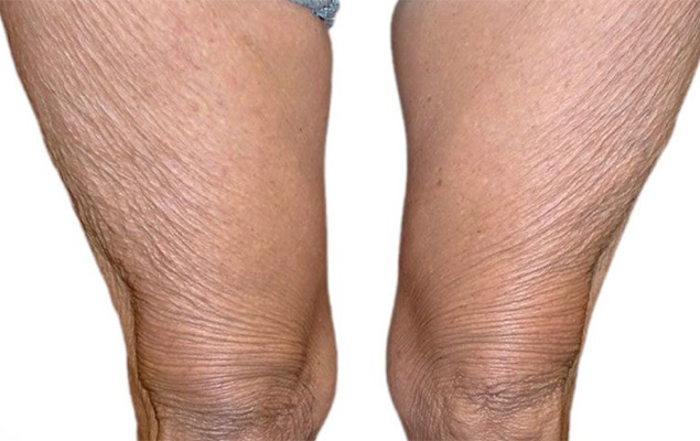 Remodelage corporel Remodelage corporel